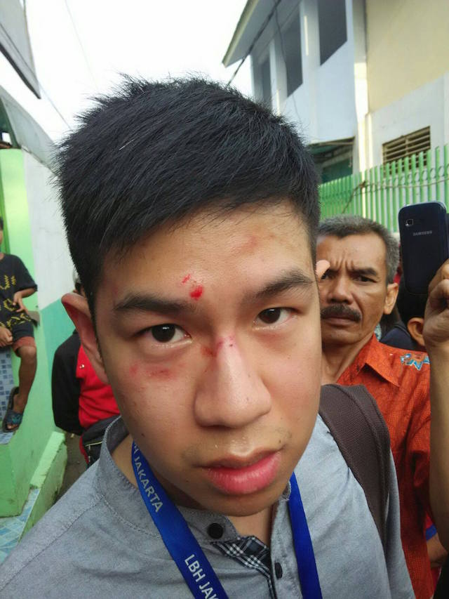 Pengacara LBH Jakarta Alldo Fellix Januardy menderita luka-luka di wajahnya setelah dipukuli oleh oknum Satpol PP di lokasi penggusuran Bukit Duri, Jakarta, pada 12 Januari. Foto dari Facebook LBH Jakarta
   