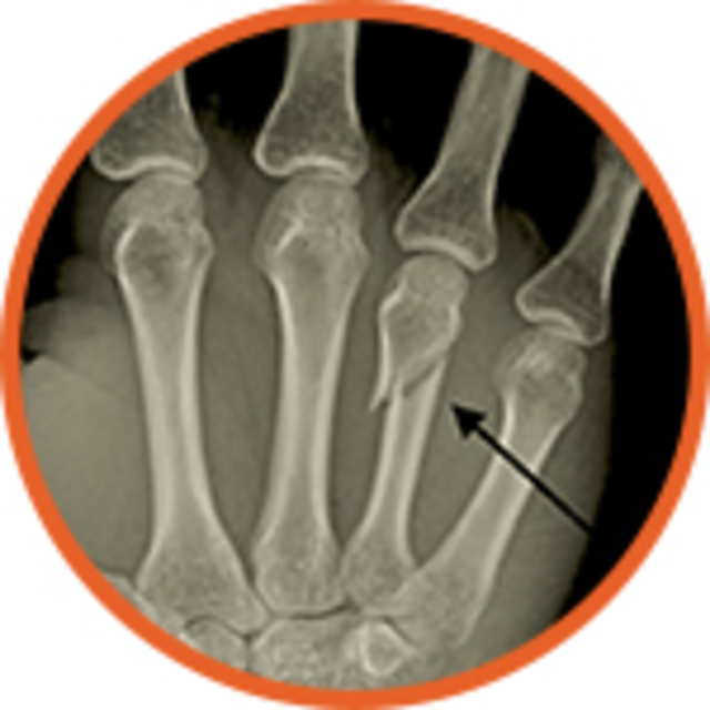 More than bruises What injuries can boxers sustain?