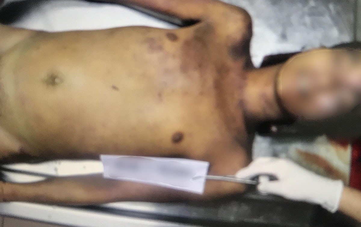 NO FOUL PLAY? Photos obtained by Rappler show bruises on the body of Genesis 'Tisoy' Argoncillo. Sourced photo 