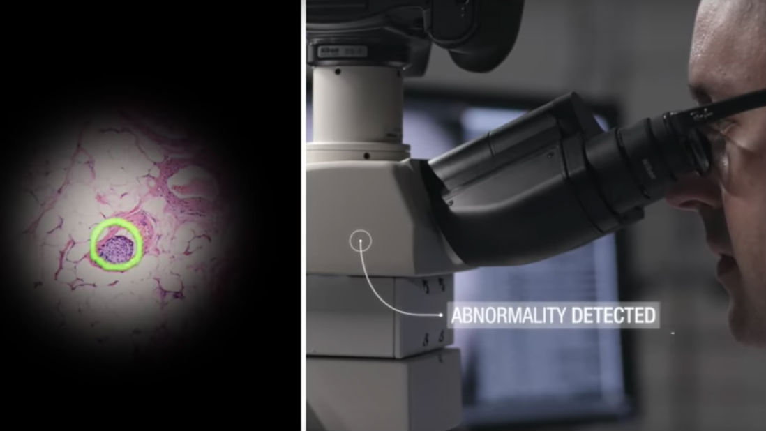 VISUALIZED DETECTION. A screenshot from a Google video demonstrates the AI- and AR-assisted microscope being developed by the search giant. Screenshot from YouTube/Google  