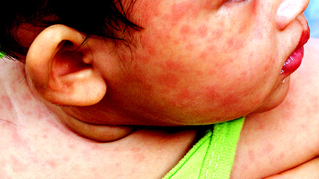 At least 70 deaths due to measles – DOH