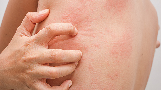 Fast Facts What Is Chronic Spontaneous Urticaria