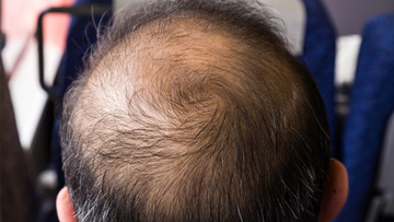 To Baldly Grow Japan Scientists Regrow Hair At Record Rate