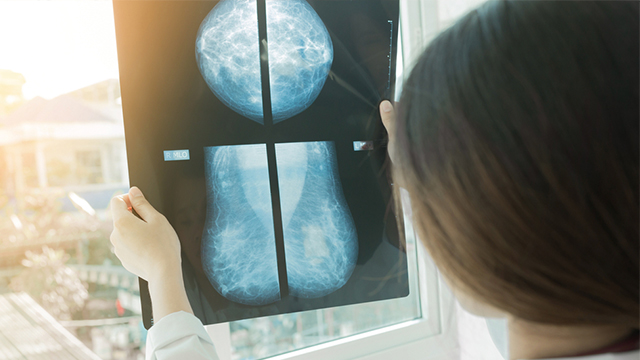 AI Beats Human Breast Cancer Diagnosis